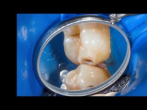 Видео: Подготовка к созданию плотного контактного пункта мини версия