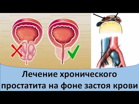 Видео: Лечение хронического простатита на фоне застоя крови