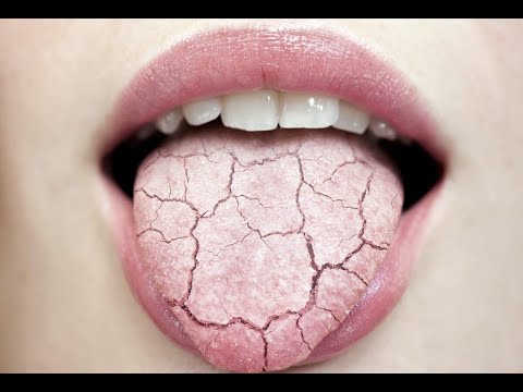 Видео: Сухость в полости рта (ксеростомия) - откуда берётся и как с ней бороться