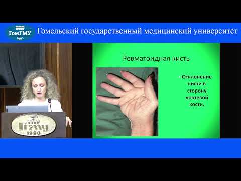 Видео: Жандарова Е.М. Особенности суставного синдрома при ревматоидном артрите и остеоартрите