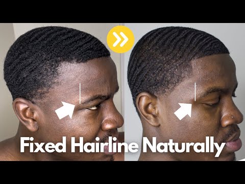 Видео: Как я естественным образом исправила линию роста волос | *Линия отступающих волос*