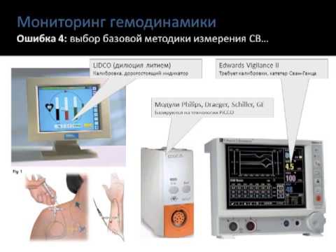 Видео: Мониторинг гемодинамики - поводные камни и осложнения (2 МСН) Кузьков В.В.