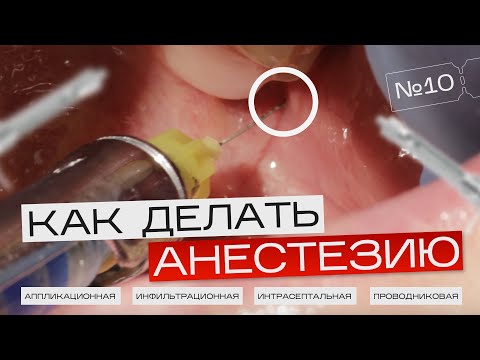 Видео: Как Правильно Делать Анестезию? Аппликационная, инфильтрационная, интрасептальная, проводниковая