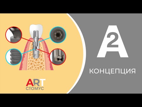 Видео: КОНЦЕПЦИЯ ИМПЛАНТАЦИОННОЙ СИСТЕМЫ А2