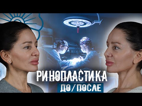 Видео: РИНОПЛАСТИКА. РЕЗУЛЬТАТ ДО И ПОСЛЕ. КСЕНИЯ САМАРИНА О РИНОПЛАСТИКЕ