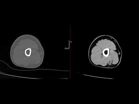 Видео: Укладка локтевого сустава для компьютерной томографии