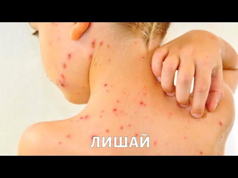 Видео: Стригущий ЛИШАЙ у ребенка: признаки и чем лечить?