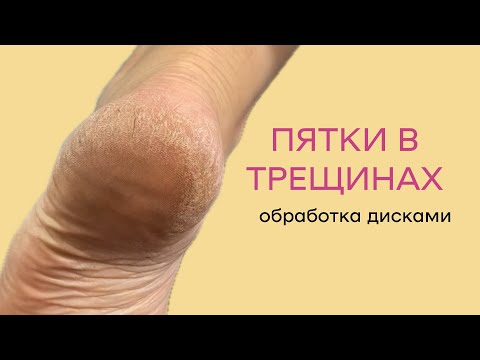 Видео: Обработка трещин педикюр; работа дисками