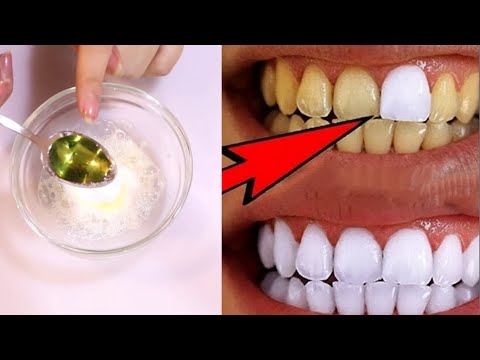 Видео: Всего за 3 минуты превратите желтые зубы в белые, сияющие, как жемчуг / Отбеливание зубов дома ll...