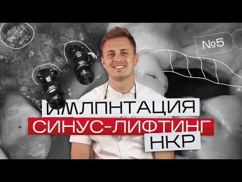 Видео: Установка имплантов с синус-лифтингом и НКР. Игорь Налиткин