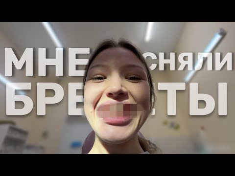 Видео: МНЕ СНЯЛИ БРЕКЕТЫ /итоговая цена, показываю процесс и отвечаю на ВСЕ вопросы, ВЛОГ