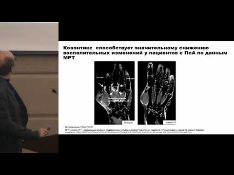 Видео: Ильевский И.Ю., Назначение ГиБП биологически-наивному пациенту СПСа:проблема, дилемма или..