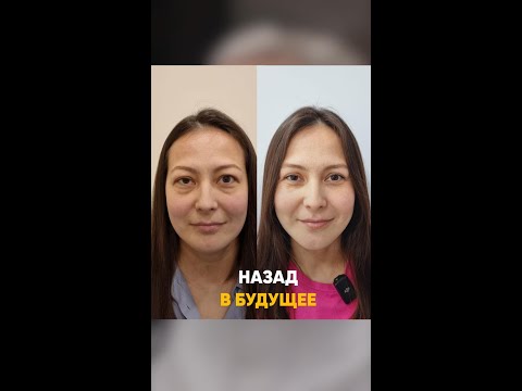 Видео: Эндокринная офтальмопатия, которая развилась на фоне беременности