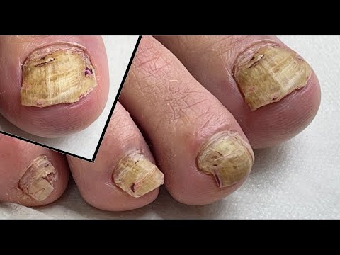 Видео: Зачистить всё😬. Подтверждённый онихомикоз🍄.