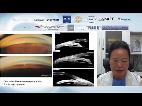 Видео: Каковы механизмы закрытия угла передней камеры? Все ли они учитываются в клинической практике?