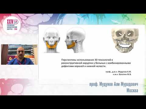 Видео: Перспективы использования 3D технологий в реконструктивной хирургии у онкобольных