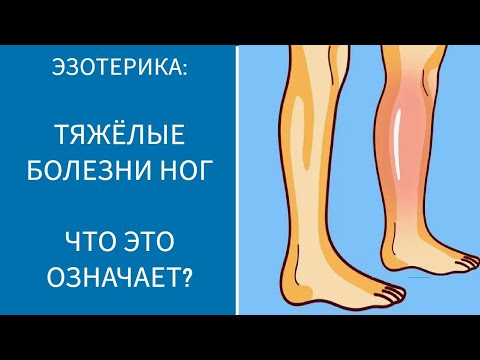 Видео: ТЯЖЁЛЫЕ БОЛЕЗНИ НОГ. ЧТО ЭТО ОЗНАЧАЕТ?
