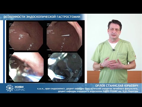 Видео: Чрескожная эндоскопическая гастростомия для пациентов с БАС