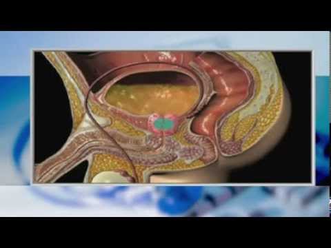 Видео: Хил клиник: Какви проблеми може да създаде простатата? Hill Clinic: Prostate Problems?