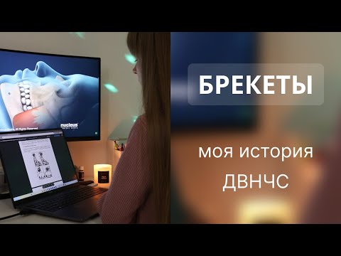 Видео: Посмотри это, если хочешь поставить брекеты или элайнеры | Моя история ДВНЧС