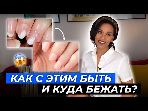 Видео: Онихолизис: смотреть мастерам и их клиентам!// Вред гель-лака//Вылечить отслоение ногтей навсегда!