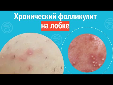 Видео: 😠 Хронический фолликулит на лобке. Клинический случай №1683