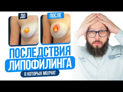 Видео: НЕ ДЕЛАЙТЕ ЛИПОФИЛИНГ, пока не узнаете об этих последствиях! Вся правда о Липофилинге. Артем Коробов
