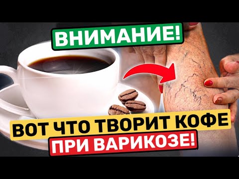 Видео: Как Кофе воздействует на варикоз?