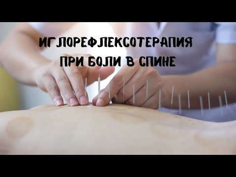 Видео: Иглорефлексотерапия