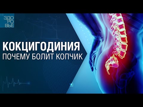 Видео: Кокцигодиния. Почему болит копчик