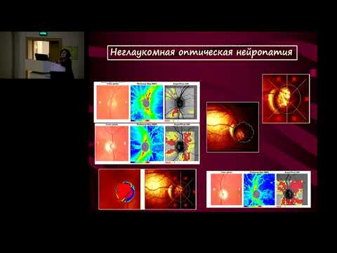 Видео: Конференция «Актуальные вопросы нейроофтальмологии. Патология зрительного нерва»