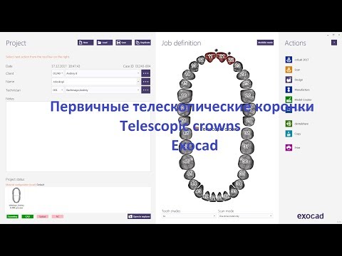 Видео: Первичные телескопические коронки в Exocad