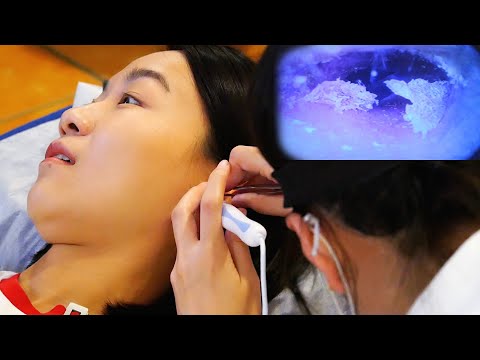 Видео: удаление ушной серы - ASMR