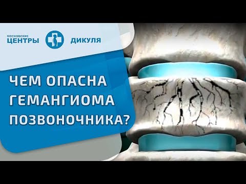 Видео: Гемангиома позвоночника