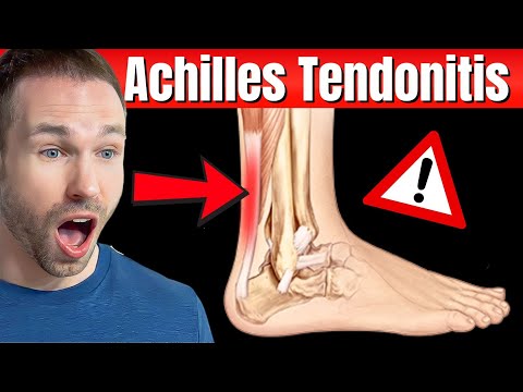 Видео: Как вылечить ахиллотендинит: научно обоснованные методы устранения боли