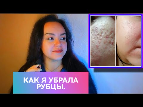 Видео: УБРАЛА РУБЦЫ!✅Без лазерных шлифовок❌