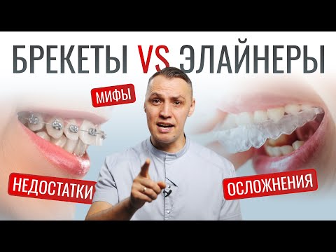 Видео: БРЕКЕТЫ VS ЭЛАЙНЕРЫ