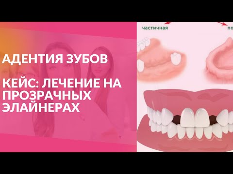 Видео: Адентия зубов #адентия #стоматологиямосква #доктор #ортодонтическоелечение #ортодонтмосква #элайнеры