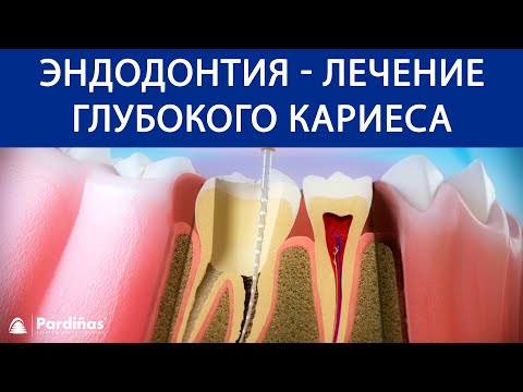 Видео: Эндодонтия - Лечение глубокого кариеса ©