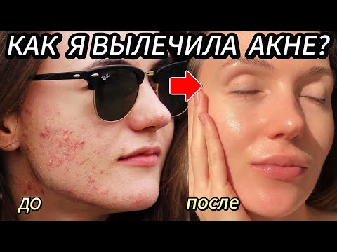 Видео: КАК Я ВЫЛЕЧИЛА ПРЫЩИ? ВСЯ ПРАВДА О СИСТЕМНЫХ РЕТИНОИДАХ