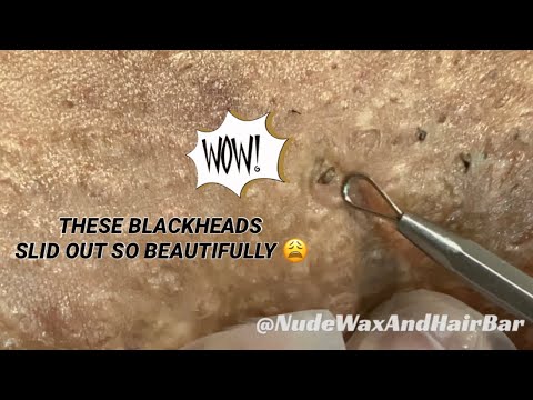 Видео: Удаление черного угрей у клиента, страдающего гидраденитом