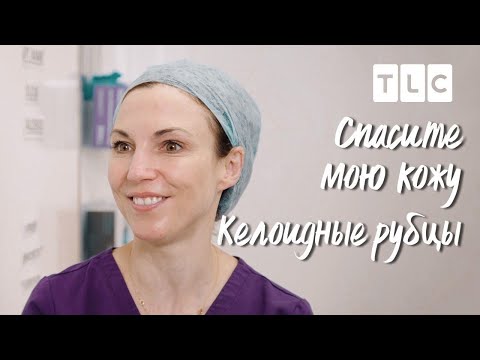 Видео: Келоидные рубцы | Спасите мою кожу | TLC