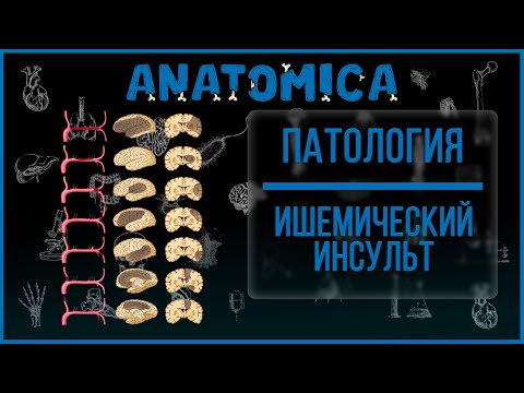 Видео: Ишемический инсульт  - симптомы и синдромы / Патология