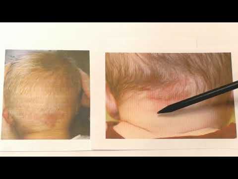 Видео: Красные сосудистые пятна у новорожденных