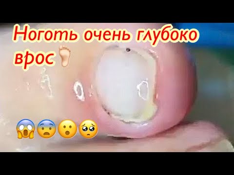 Видео: Ноготь🦶🏻который очень глубоко врос😨😱