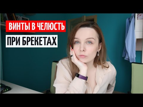 Видео: Винты в Челюсть при Брекетах |  Больно или нет? Винты при брекетах Москва