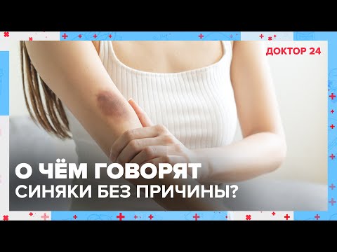 Видео: О чём говорят СИНЯКИ на теле без причины? | Доктор 24
