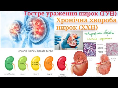 Видео: Гостре ураження нирок. Хронічна хвороба нирок лекція (подкаст ). Гостра ниркова недостатність