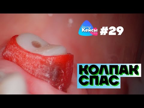 Видео: Колпак спас | Дентал Кейсы от BG #29