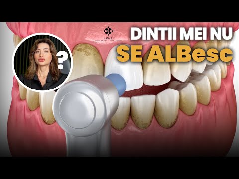 Видео: 🤍 Я чищу зубы, но они не отбеливаются? — Стоматологическая клиника Lema